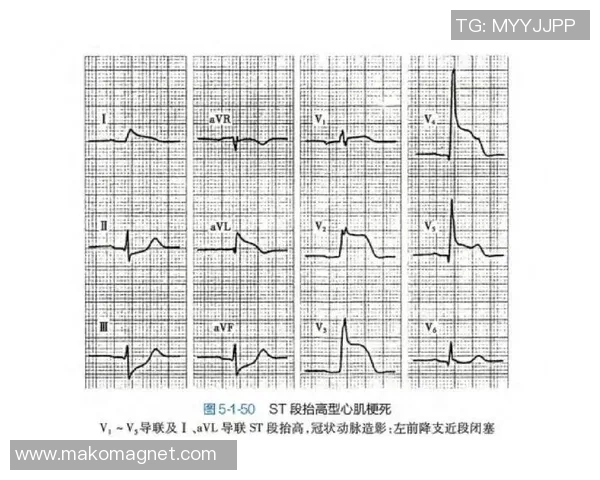 专业解读：V5的盯防打法
